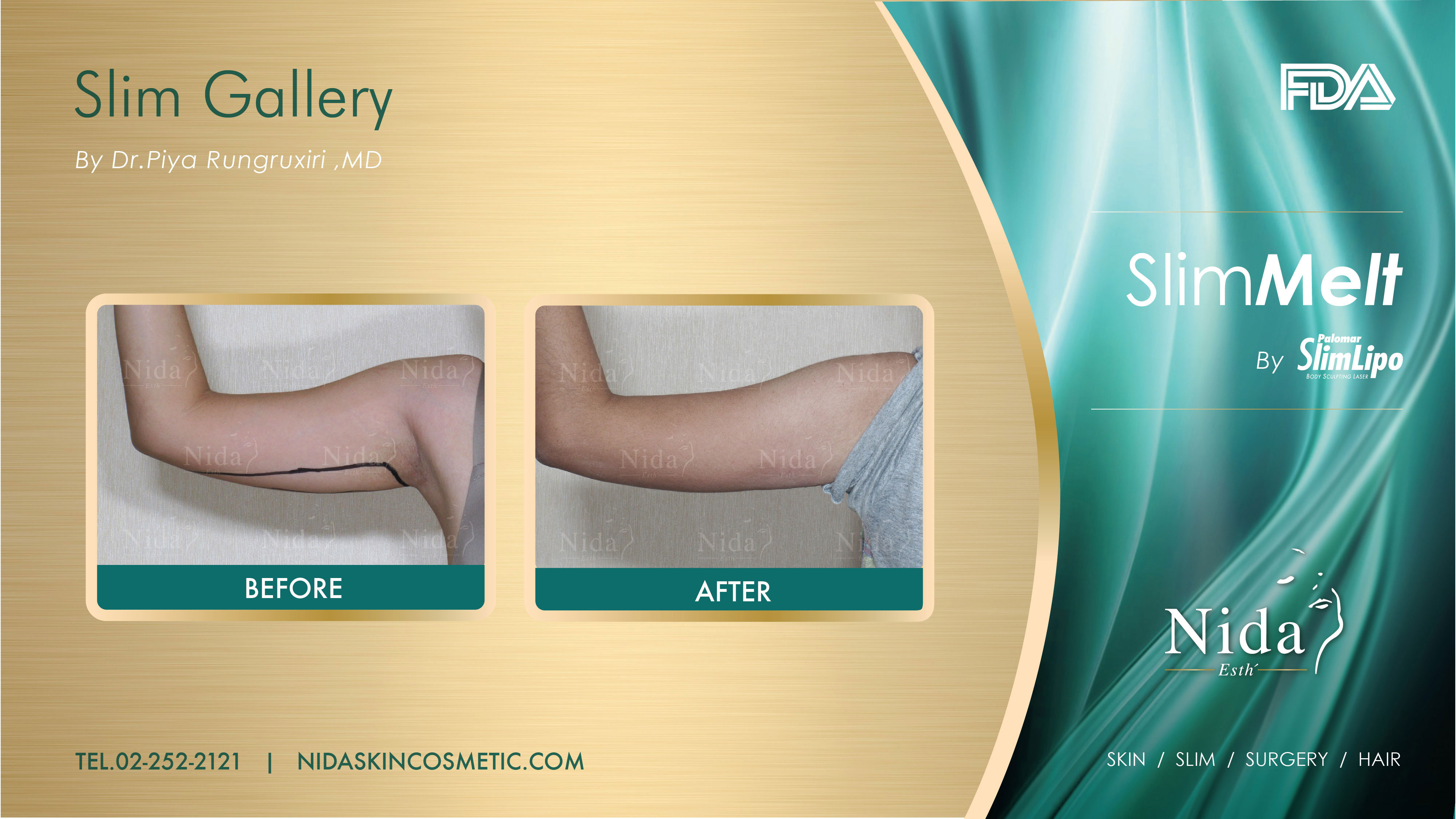 Upper Arm Liposuction by Slim Melt Nida Esthetic Cosmetic Surgery Bangkok