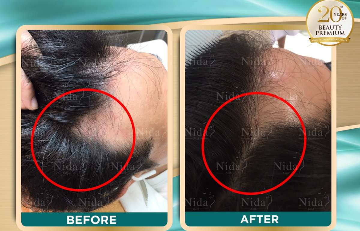 I've gotten a problem of thin hair for almost half of my entire life and  I've always been using medicines to treat it. | Nida Esthetic Cosmetic  Surgery Bangkok