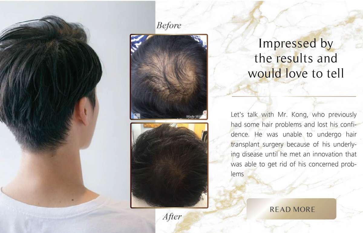UR Cell Micro Hair Transplant | Nida Esthetic Cosmetic Surgery Bangkok