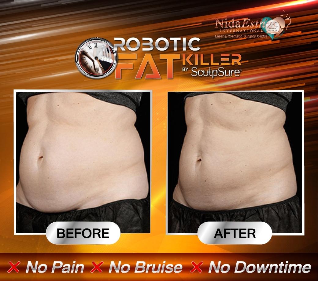 SculpSure Before After