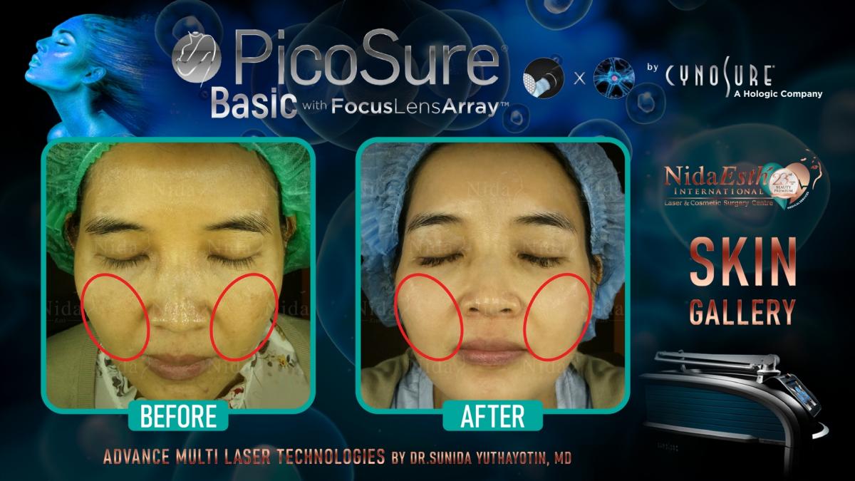 PicoSure before after